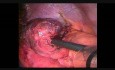 Nécrose gastrique dans une hernie diaphragmatique chez un patient avec l'anneau gastrique