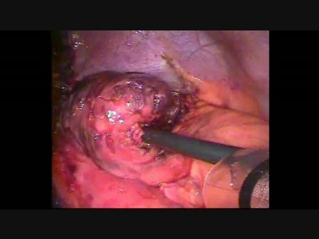 Nécrose gastrique dans une hernie diaphragmatique chez un patient avec l'anneau gastrique