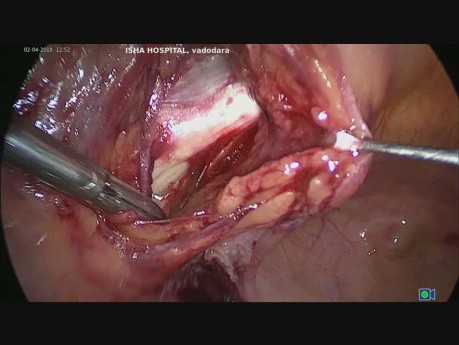 TLH et suspension de la voûte vaginale par pectopexie (partie 2)