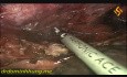 Oesophagectomie thoraco-laparoscopique en position couchée avec curage ganglionnaire du médiastin