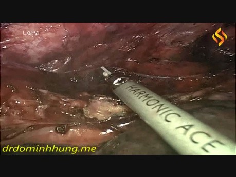 Oesophagectomie thoraco-laparoscopique en position couchée avec curage ganglionnaire du médiastin