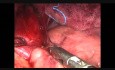 Cardiomyotomie de Heller par voie laparoscopique