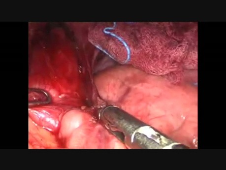 Cardiomyotomie de Heller par voie laparoscopique