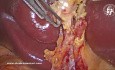 Cholangiogramme Anatomique Biliaire en Direct