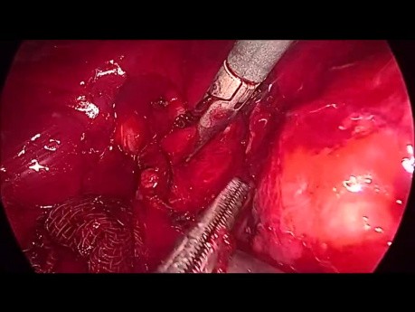 Exploration laparoscopique du canal biliaire commun. Saignement de l'artère supraduodénale