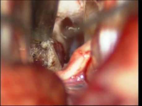 Tumeur du Tronc Cérébral - Gliome Pontin - Ablation Microchirurgicale