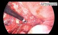 Ablation de l'endométriome ovarien pour la préservation du parenchyme ovarien