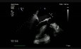 Endocardite infectieuse sur bioprothèse aortique