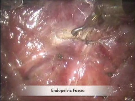 Résection abdominale cylindrique robotique avec transsection de releveur transabdominal