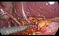 Lithiase de la voie biliaire principale, traitement laparoscopique