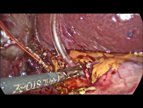 Lithiase de la voie biliaire principale, traitement laparoscopique