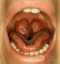 Hypertrophie des tonsilles palatines