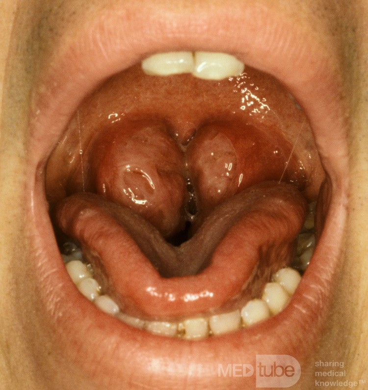 Hypertrophie des tonsilles palatines