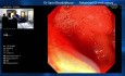 Vue Endoscopique de la Papille Mineure du Pancréas Divisum