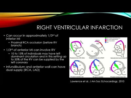 Échocardiographie : Infarctus Aigu du Myocarde