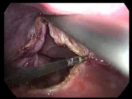 Kyste hépatique simple - Fenestration (deroofing) par laparoscopie