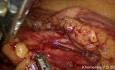 Traitement Chirurgical d'un Cancer du Côlon Sigmoïde Avancé