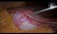 Tissu Hépatique Aberrant à la Surface de la Vésicule Biliaire