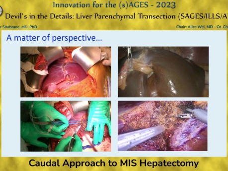 Approche Caudale de l'Hépatectomie Mini-invasive