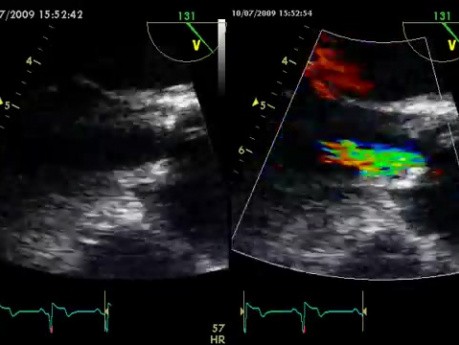 Une membrane fibreuse sous-valvulaire aortique 