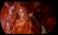 Pancréatectomie distale avec conservation de la rate par laparoscopie pour une tumeur pseudopapillaire et solide du pancréas avec saignement de la veine splénique