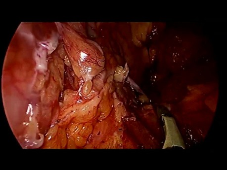 Pancréatectomie distale avec conservation de la rate par laparoscopie pour une tumeur pseudopapillaire et solide du pancréas avec saignement de la veine splénique