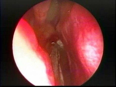 Grand polype choanal - ablation endoscopique