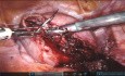 Myomectomie.