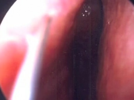 La septoplastie endoscopique -  la vidéo de chirurgie