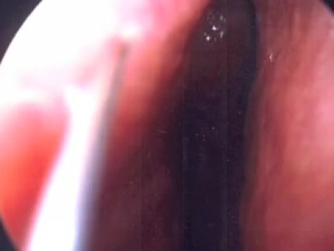 septoplastia -endoscopia
