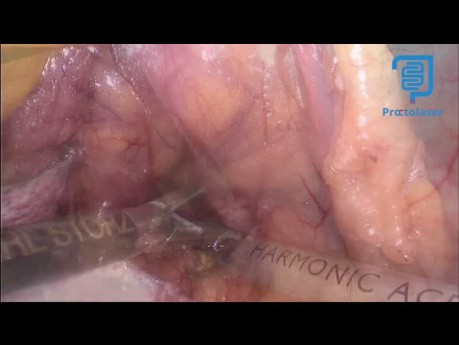 Enucléation Laparoscopique d'un Insulinome du Pancréas