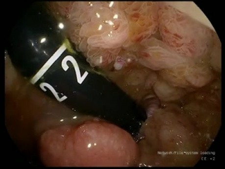 La dissection endoscopique sous-muqueuse (ESD) d'un adénome rectal - l'excision totale de la muqueuse rectale