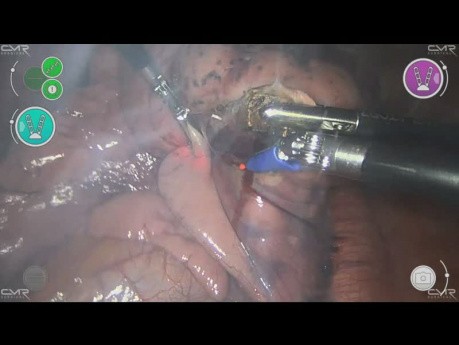 Résection des métastases pulmonaires à l'aide de robot Versius