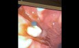 Résection endoscopique de la muqueuse de la jonction gastro-oesophagienne due à une tumeur dysplasique