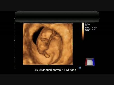 Échographie normale 4D du fœtus de 11 semaines