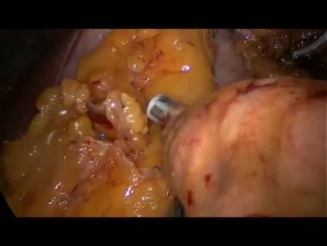 Pancréatectomie distale par laparoscopie