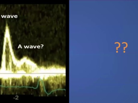 Échocardiographie et Pression de Remplissage du Ventricule Gauche 