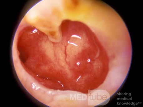 Grande perforation de la membrane tympanique sous-totale