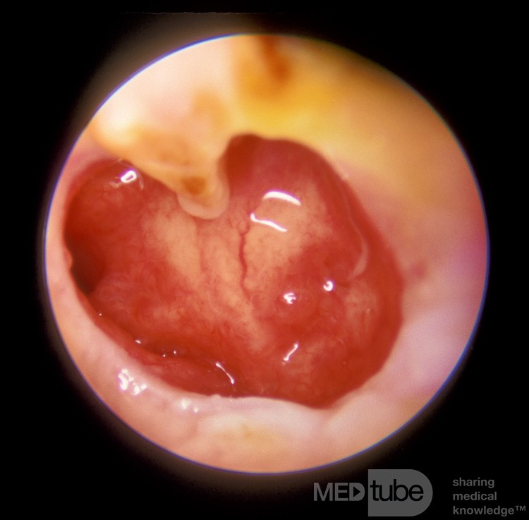 Grande perforation de la membrane tympanique sous-totale