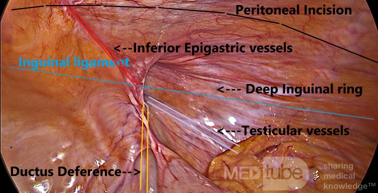 Repères dans l'Exploration Laparoscopique des Hernies TAPP
