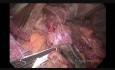 La fundoplicature de Dor avec la Myotomie de Heller par voie laparoscopique pour l'achalasie.