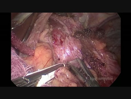 La fundoplicature de Dor avec la Myotomie de Heller par voie laparoscopique pour l'achalasie.