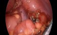 Apendicectomia