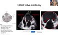 Principes de Base de l'Anatomie de la Valve Mitrale et Imagerie Pré-Interventionnelle pour la TEER Mitrale