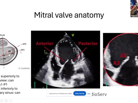 Principes de Base de l'Anatomie de la Valve Mitrale et Imagerie Pré-Interventionnelle pour la TEER Mitrale