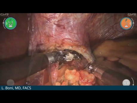 Myotomy for Achalasia with Versius – Luigi Boni