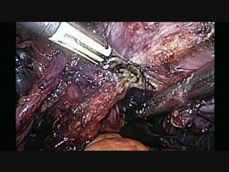 Hystérectomie Laparoscopique Totale et Curage Ganglionnaire Pelvien et Para-aortique pour Carcinome Neuroendocrinien du Col de l'Utérus