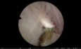 ThuFLEP Monobloc 