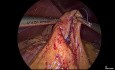 Reprise Laparoscopique d'un Pontage Gastrique Roux-en-Y en Gastrectomie Sleeve chez un Patient Présentant une Hypoglycémie Hyperinsulinémique
