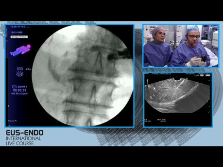 Anastomose hépatico-gastrique sous le contrôle de l'échographie endoscopique (EUS)